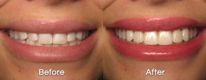 RDS-before_after_teeth_english