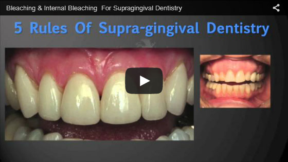 bleaching-internal-bleaching-for-supragingival-dentistry