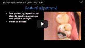 occlusal-adjustment-of-a-single-tooth-by-dr-ruiz