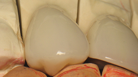 course occlusal level 1 image