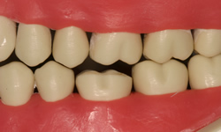 Simple by Design: Better, Simpler and More Predictable Restorative Dentistry Using Advanced Adhesion
