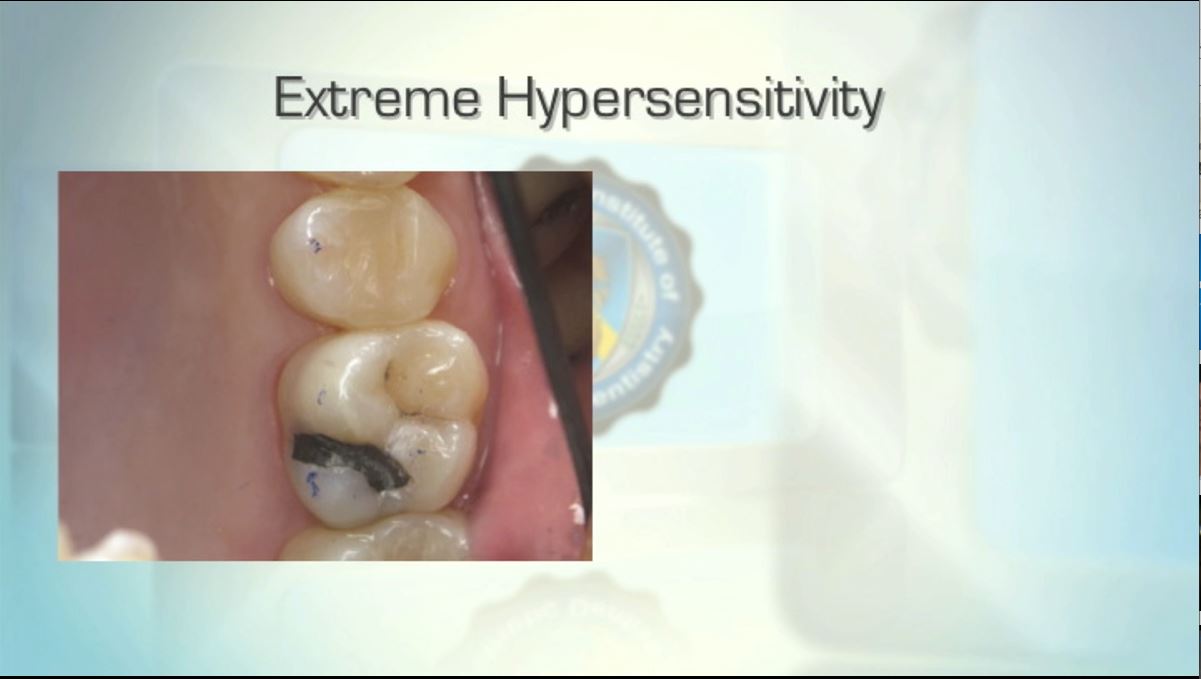 Minimizing Post-Operative Sensitivity - Los Angeles Institute of ...